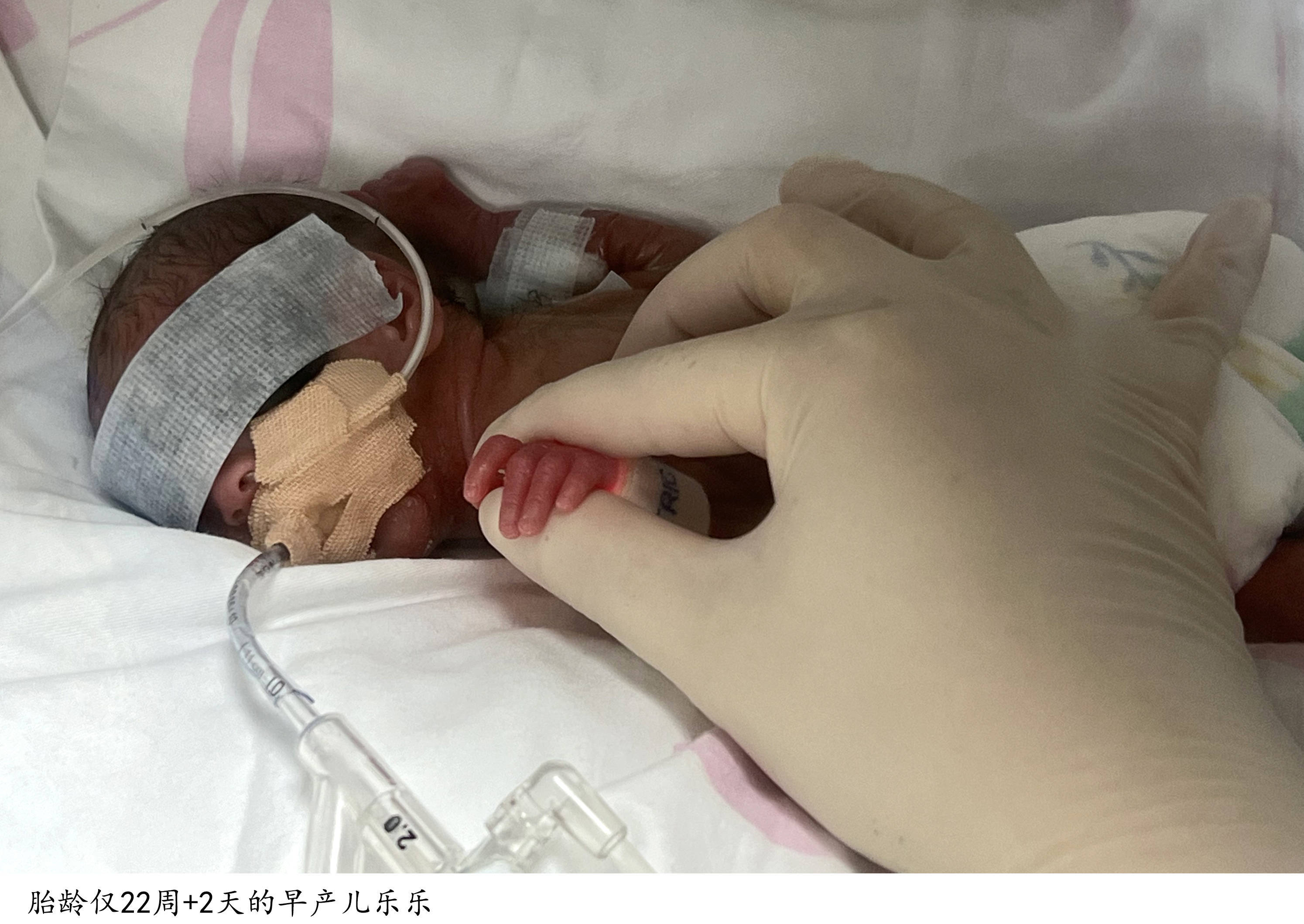 比矿泉水瓶还小、胎龄仅22周，复旦儿科医院成功救治一名超早产儿
