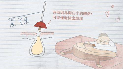 粉刺贴拔出来的真的是粉刺吗？它到底是什么？