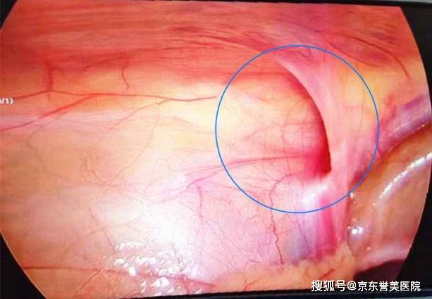 孩子小腹突然鼓了个大包，严不严重？需要去看吗？